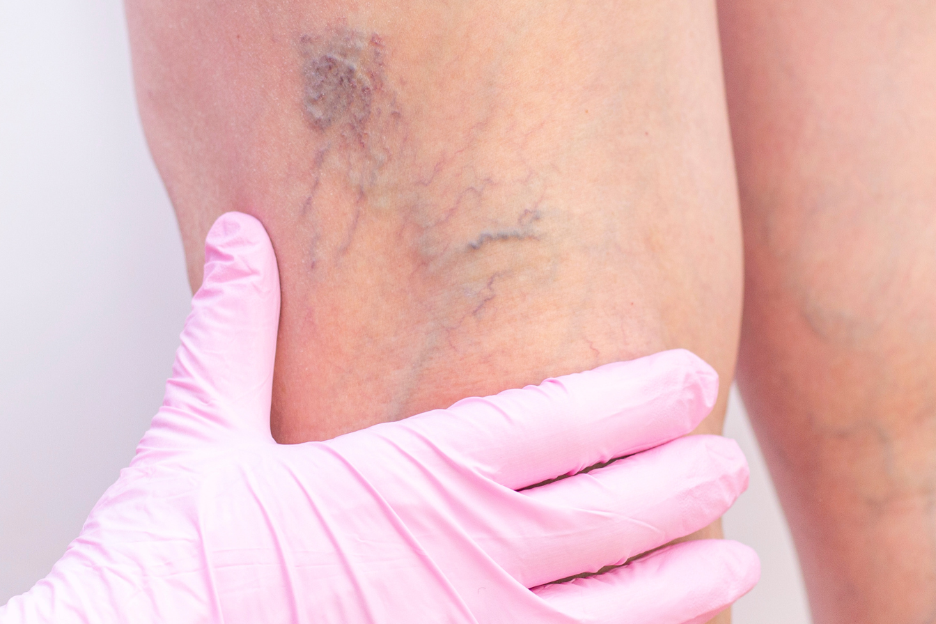 Laser for redness & vascular concerns National Skin Cancer Centres